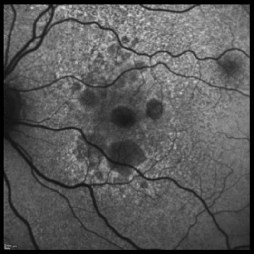 Geographic_Atrophy-Desmettre-London-Ophthalmology