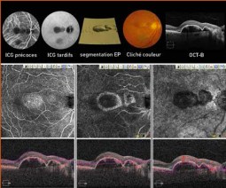 Thomas-Desmettre-Age-related-Macular-Degeneration-2017